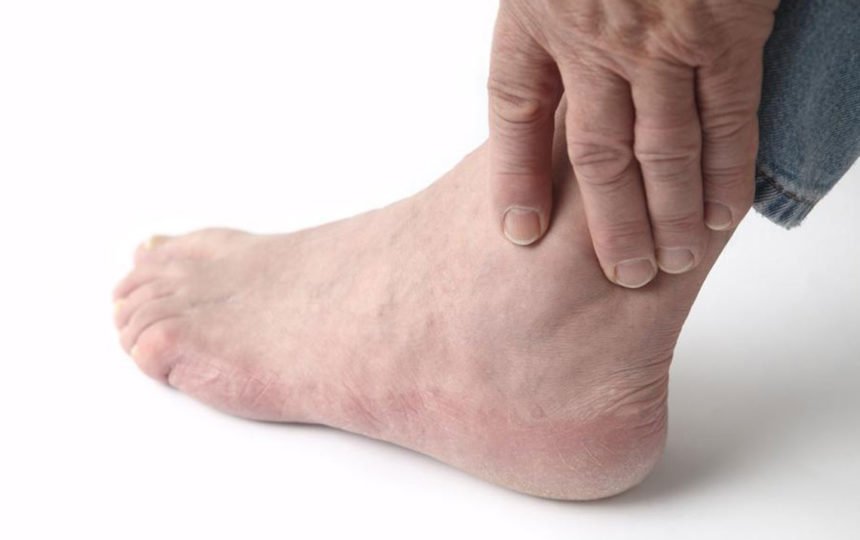 Home treatment for relief from gout foot pain ...