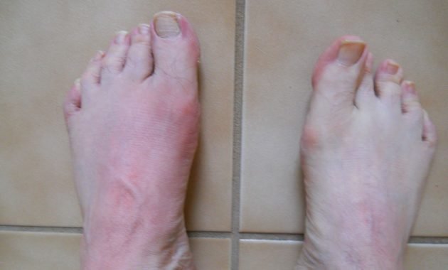 How Do You Get Gout In Feet?