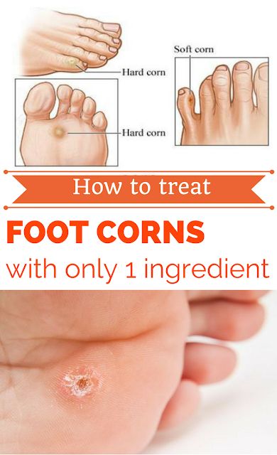 How do you treat a corn on your foot?