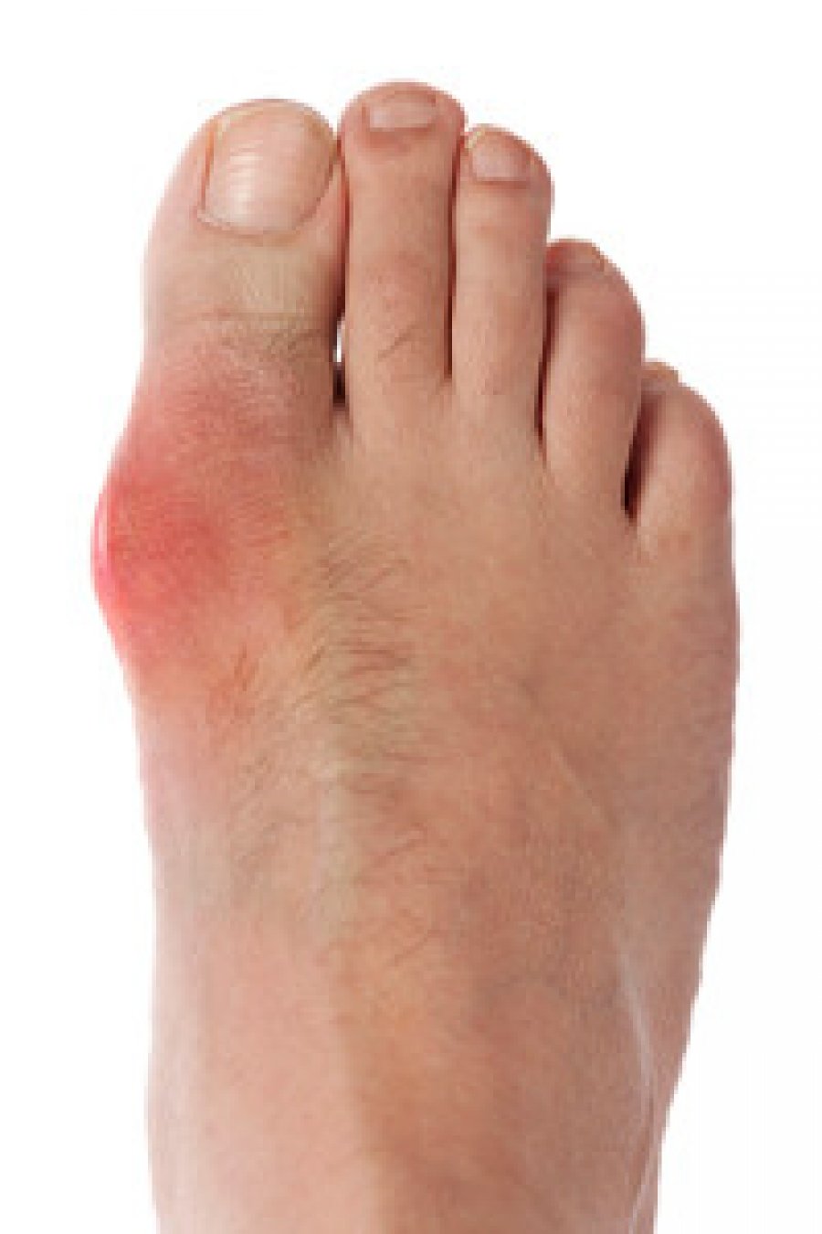 How Does A Gout Attack Happen?
