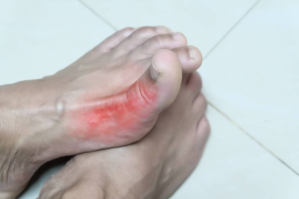 How Gout Affects Your Feet