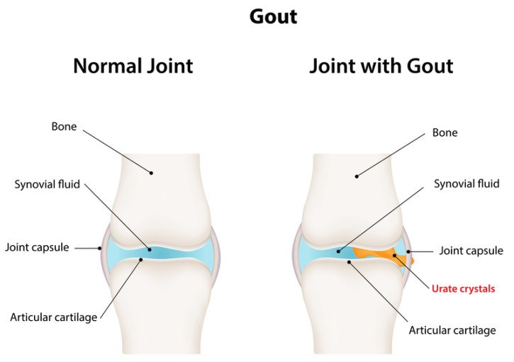 How Long Does Gout Last? These 3 Factors Determine the Answer ...