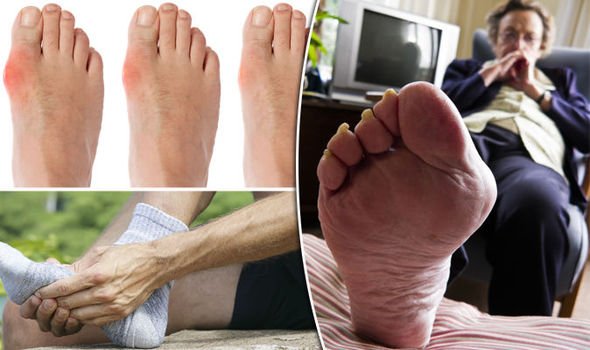 How to cure gout with simple lifestyle changes