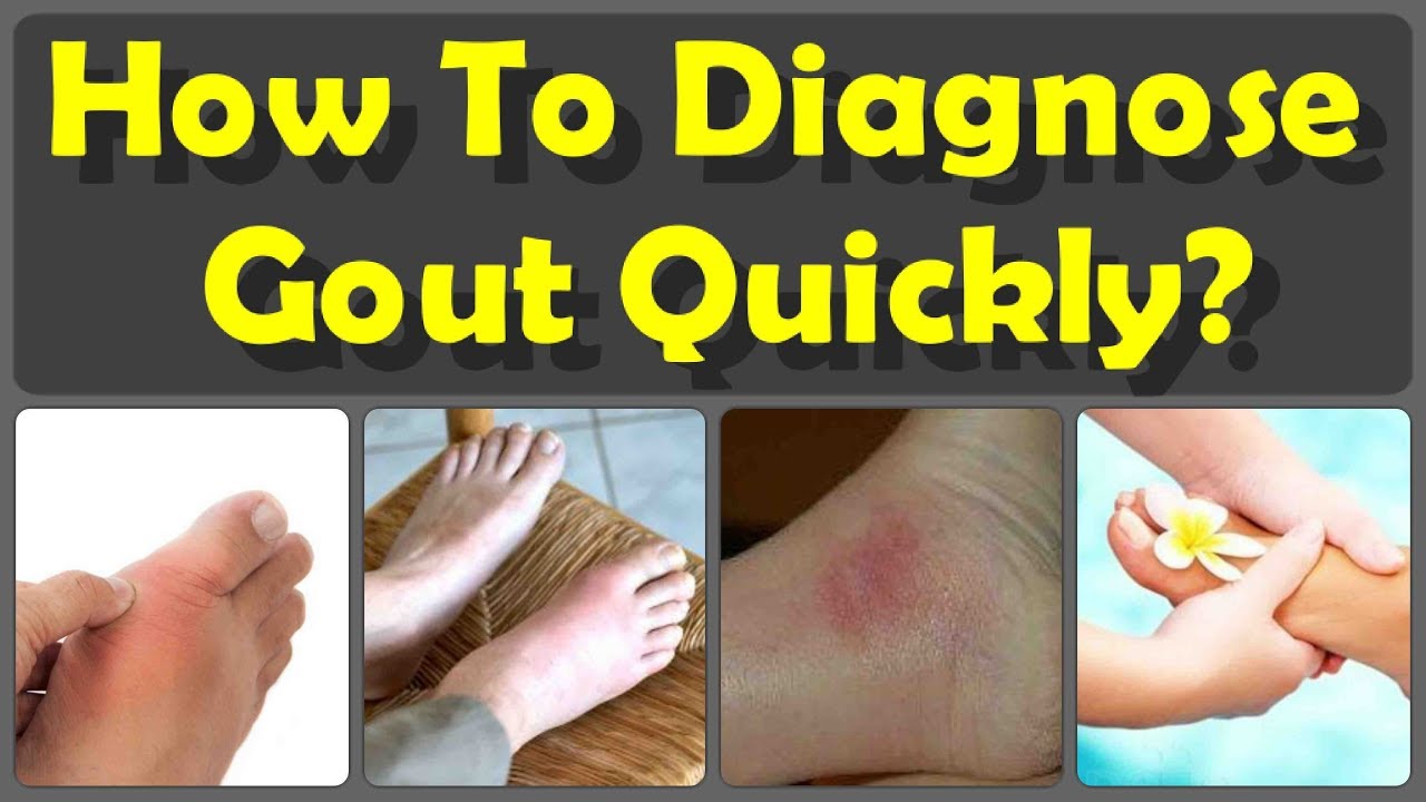 How To Diagnose Gout Attack Pain And Kill Your Gout ...