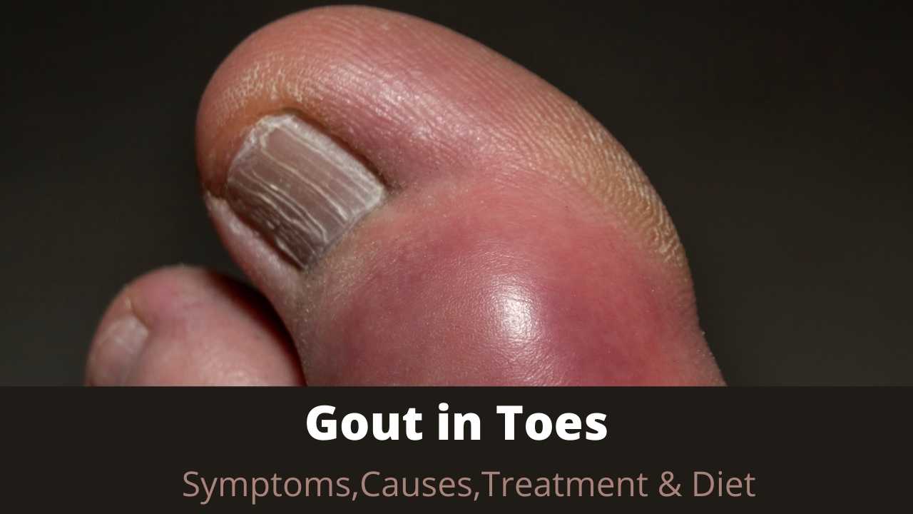 How to Eliminate Gout in Toes