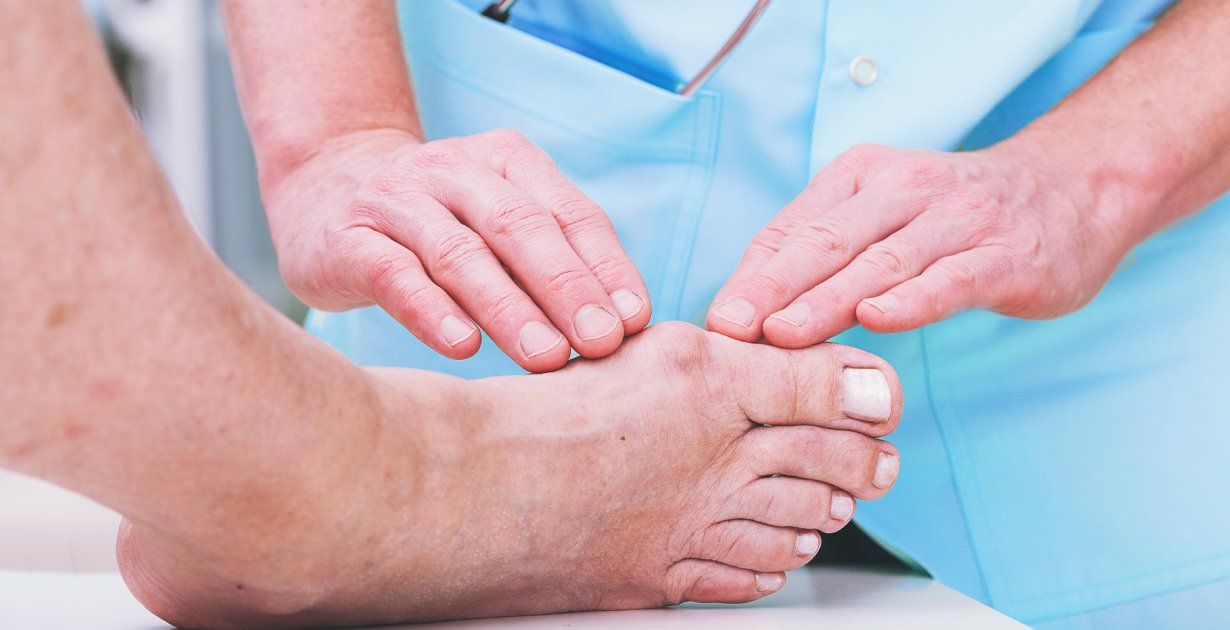 How to Get Rid of a Bunion