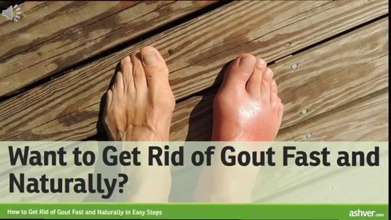 How to Get Rid of Gout Fast and Naturally in Easy Steps