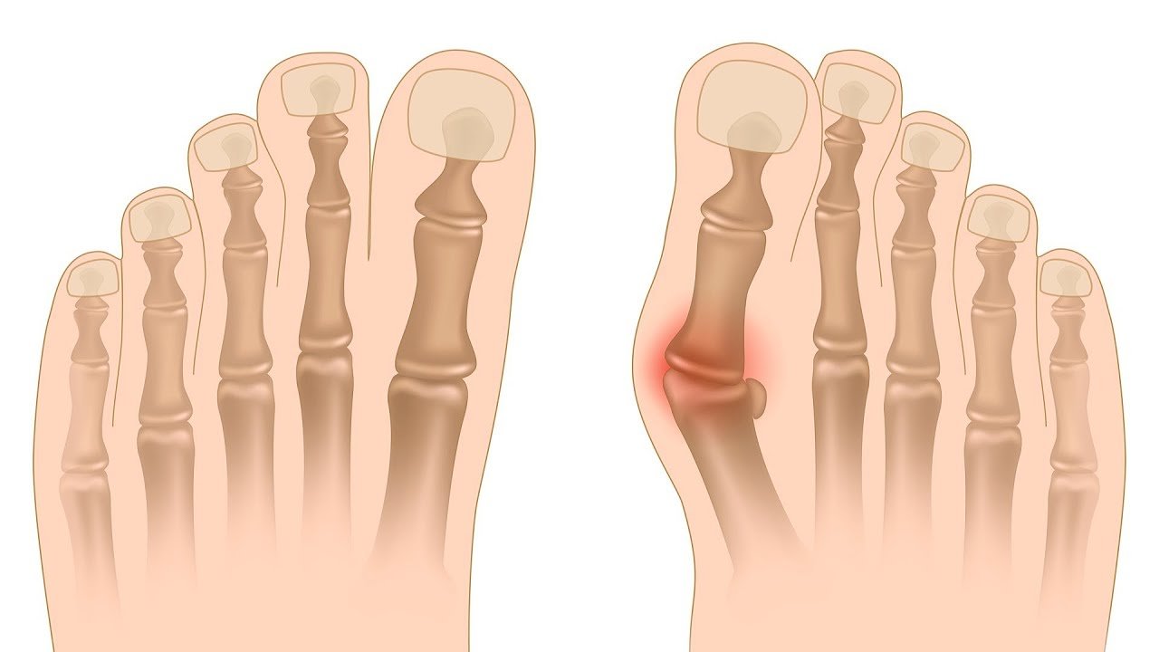 How to Know If You Have a Bunion