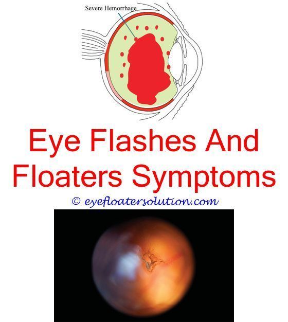 how to make eye floaters go away gout and eye floaters ...