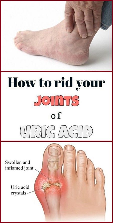 How To Naturally Get Rid Of Uric Acid Crystals In The ...
