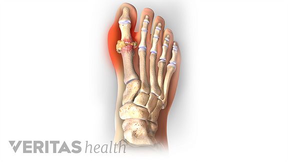 How to Prevent the Next Gout Attack