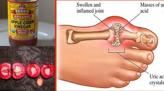 How To Quickly Remove Uric Acid Crystallization From Your Body To ...
