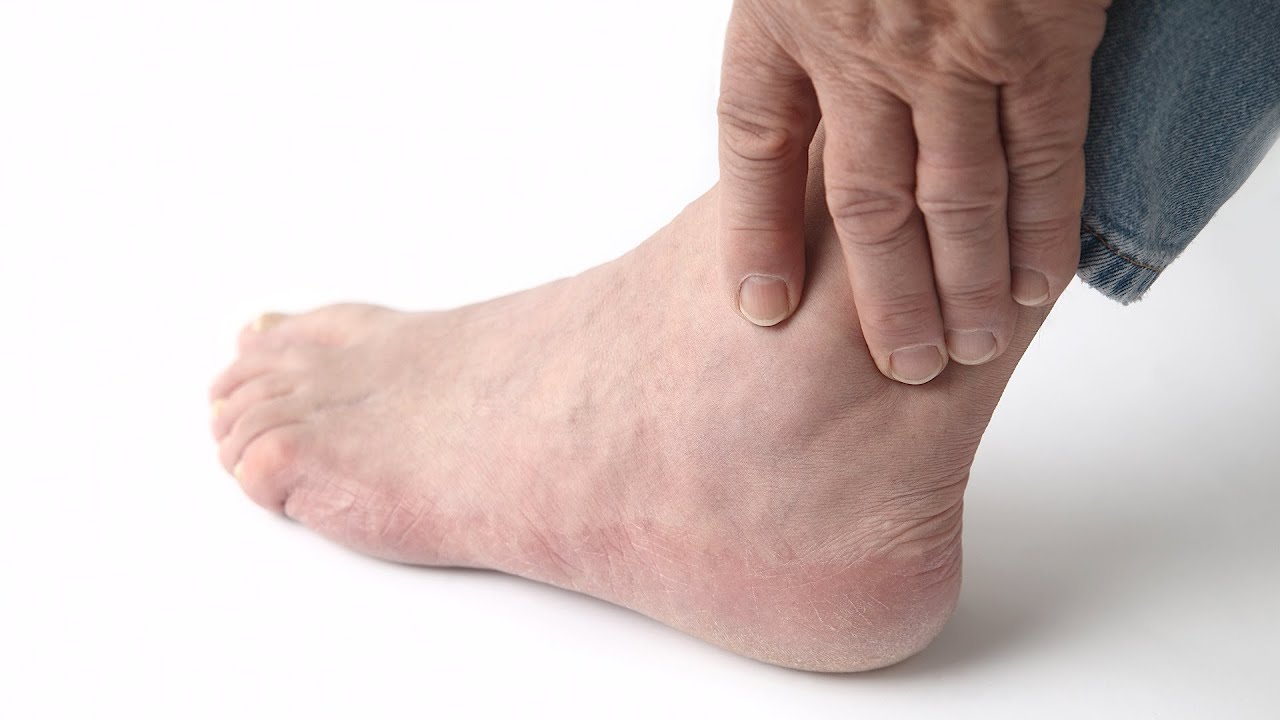 How to Recognize Gout Symptoms