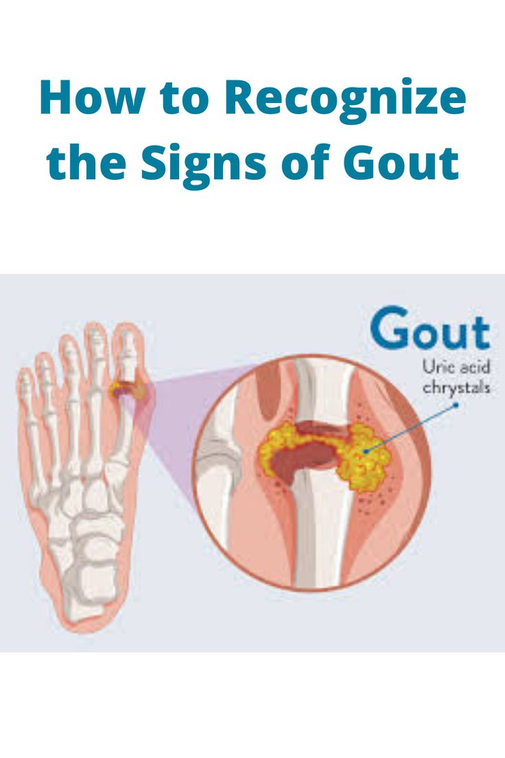 How to Recognize the Signs of Gout