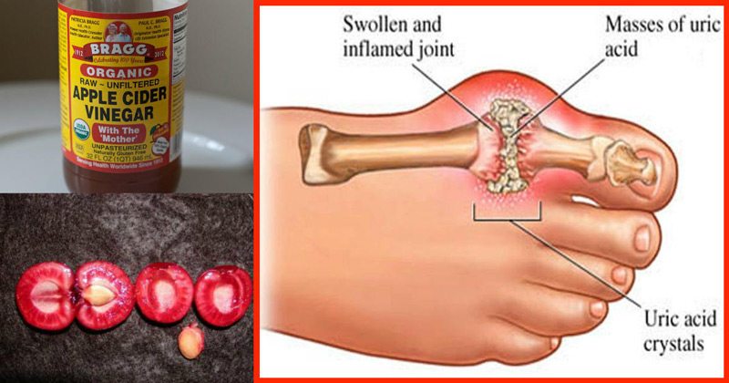 How To Remove Quickly Uric Acid From Your Body And Reduce ...