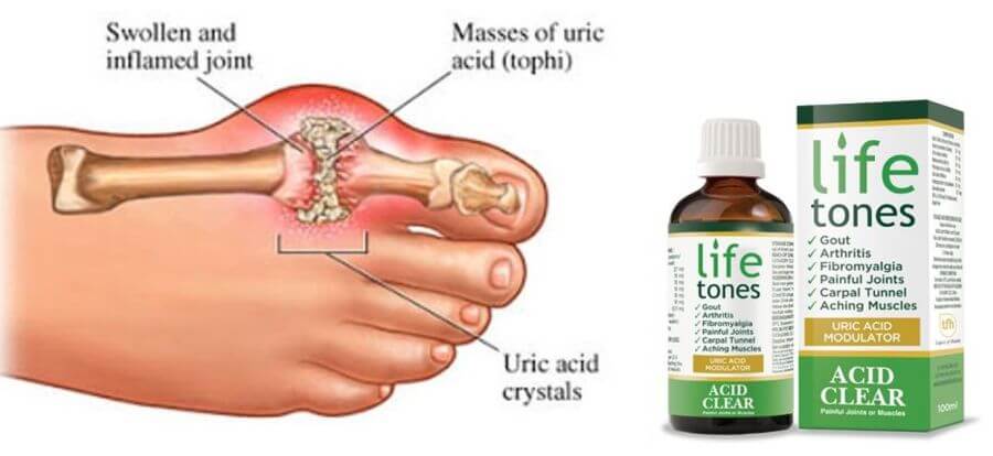 How to Successfully Treat a Gout Attack
