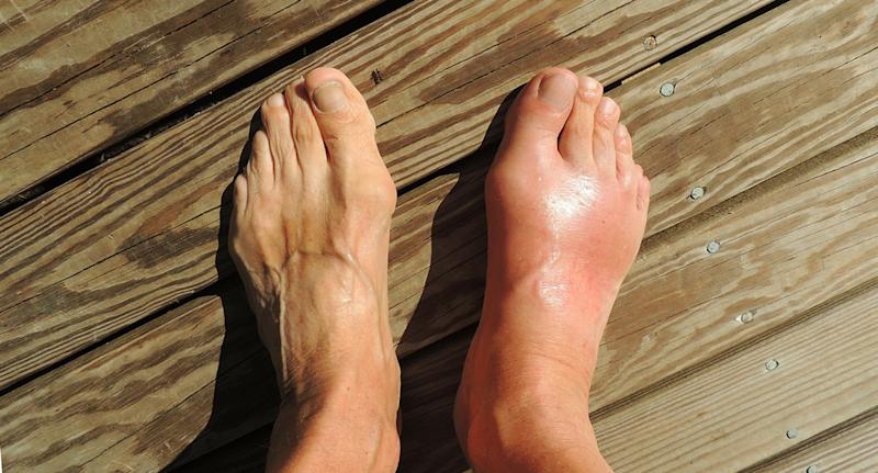 How to tell you have gout  and how to avoid it