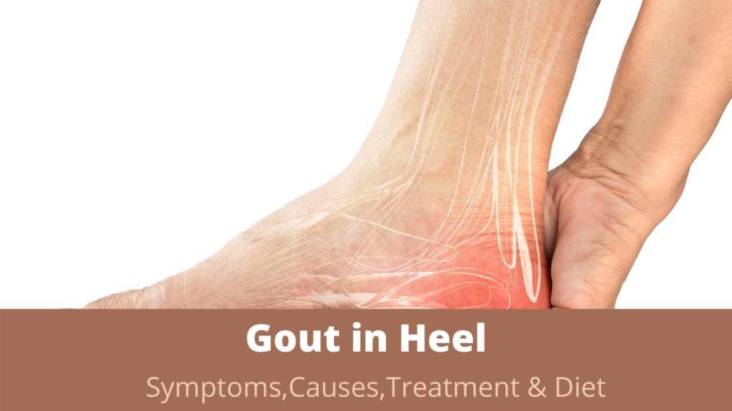How to Treat Gout in Heel with Home Remedies