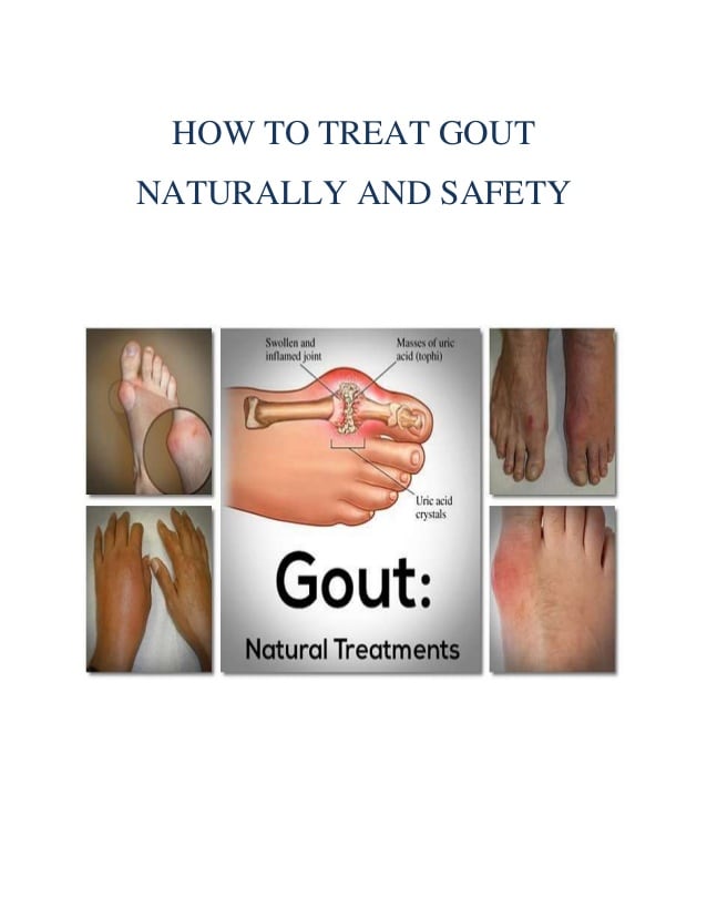 How to treat gout naturally and safety.