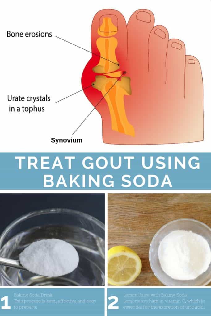 How to Treat Gout using Baking Soda ...