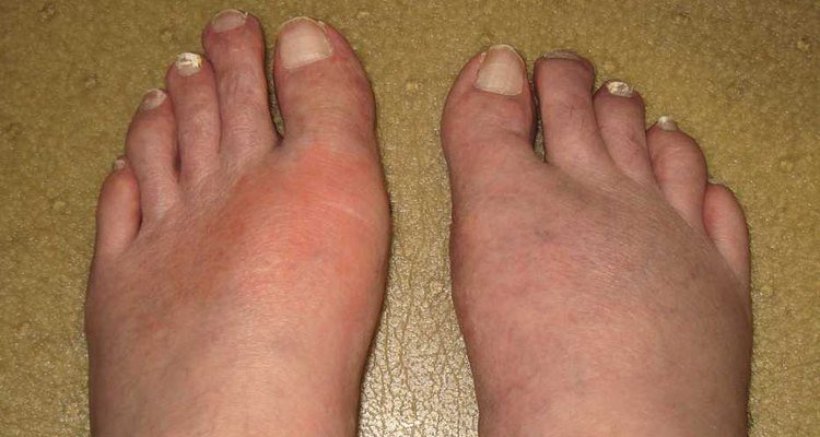 How to Use Natural Remedies to Treat Gout