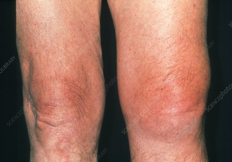 Inflamed knee of an elderly man affected by gout