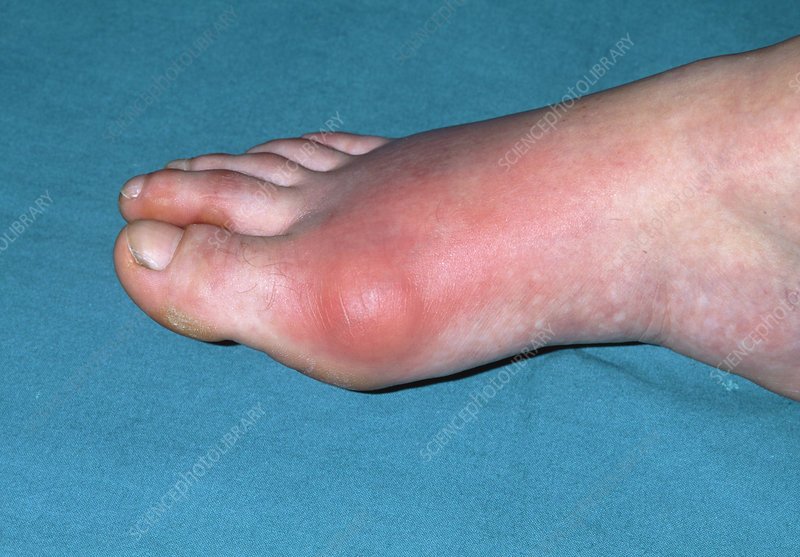 Inflamed toe joint in patient with gout