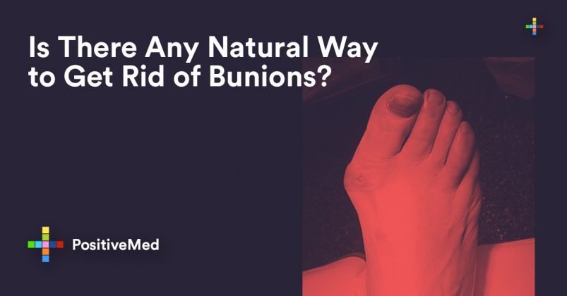 Is There Any Natural Way to Get Rid of Bunions?