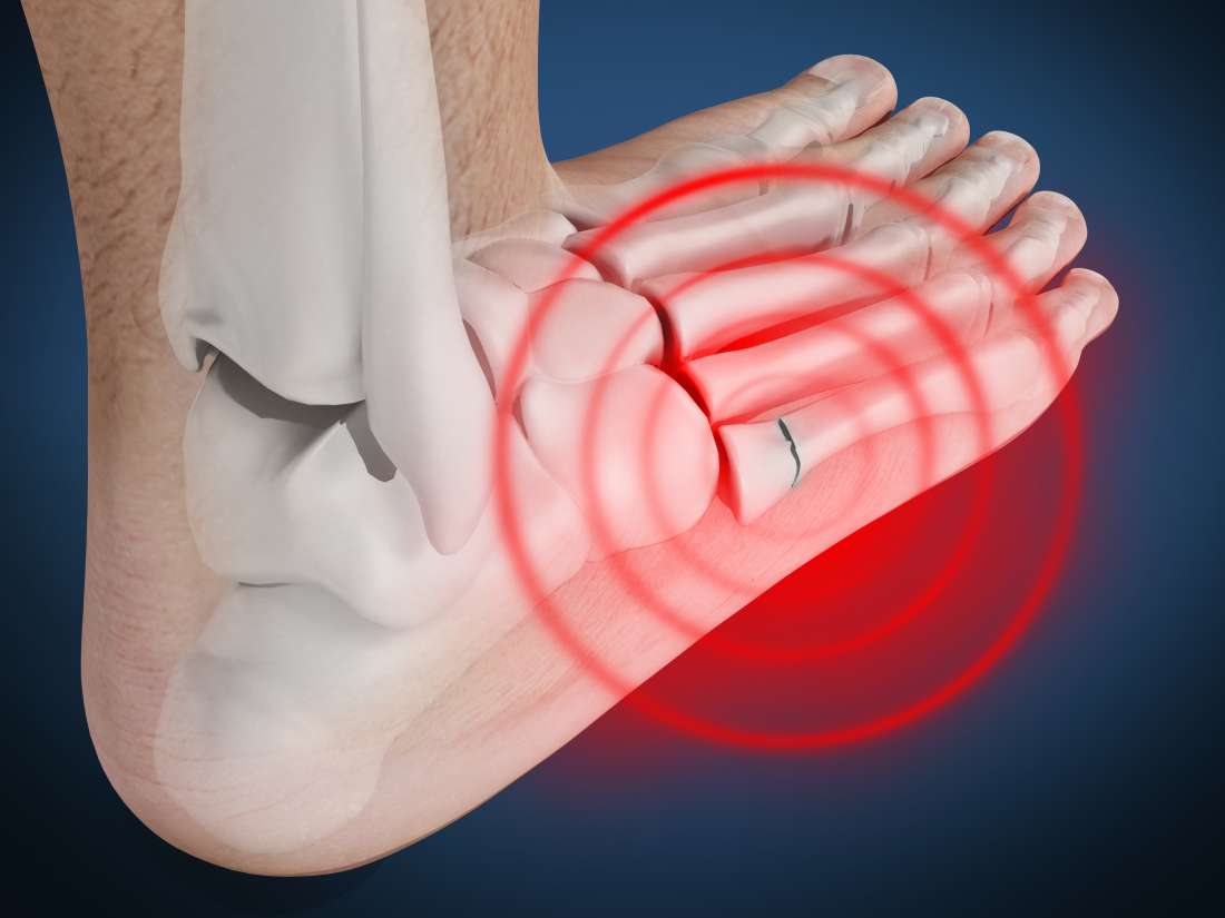 Jones fracture: Causes, symptoms, and treatment