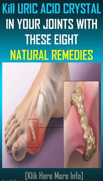 Kill URIC ACID CRYSTAL IN YOUR JOINTS WITH THESE EIGHT NATURAL REMEDIES ...