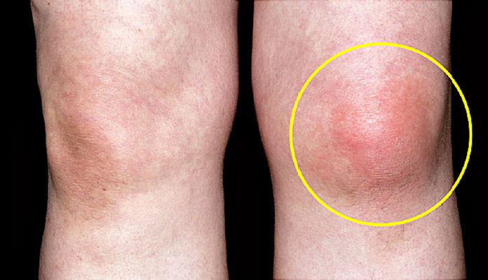 Knee Pain: Causes, Symptoms and Treatments
