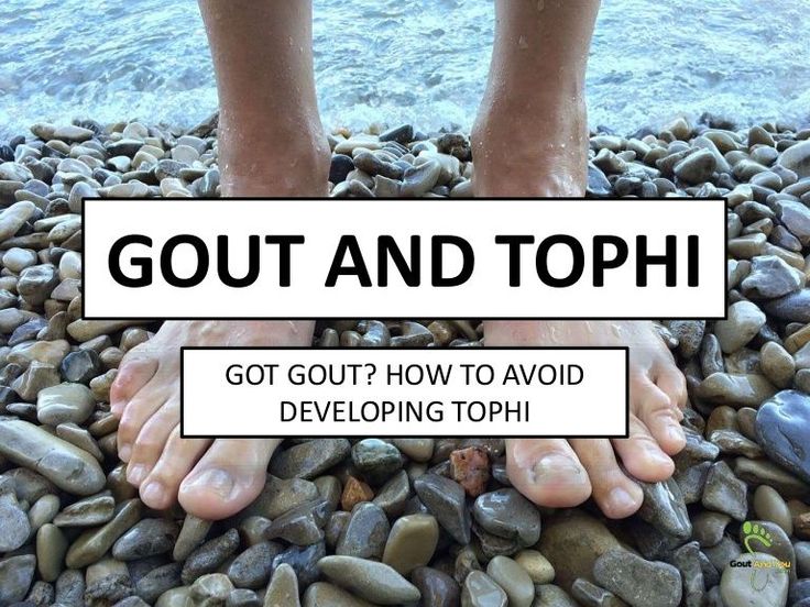 Learn about a gout complication called #tophi.