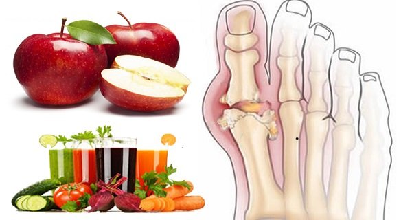 Learn How To Relieve Pain From Gout In Foot Naturally ...