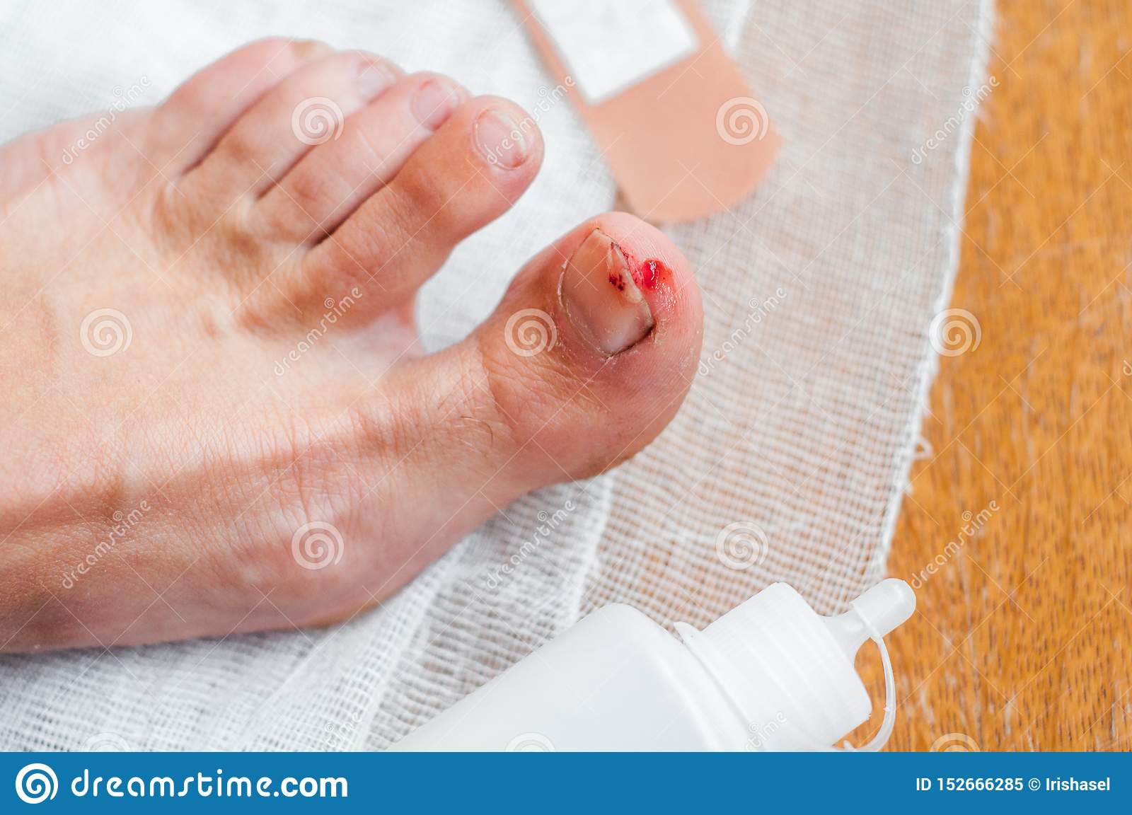 Man With Painful And Inflamed Gout On His Foot Around The Big Toe Area ...