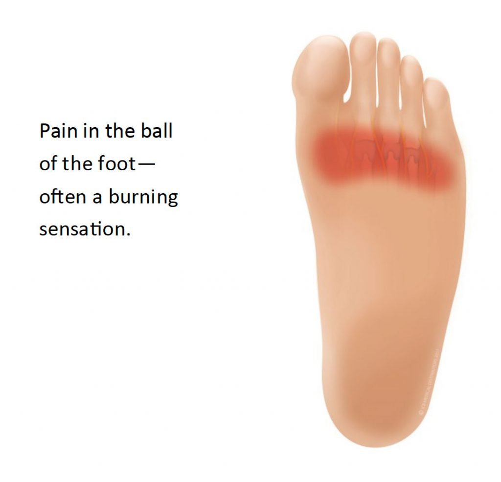 Metatarsalgia: Ball of Foot Pain