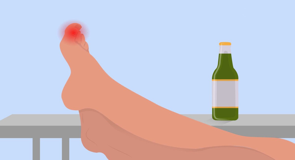 Must I Stop Drinking for Gout to Go Away?