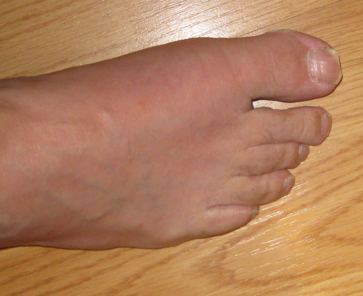 My First Week of Gout Pain and How I Treated It