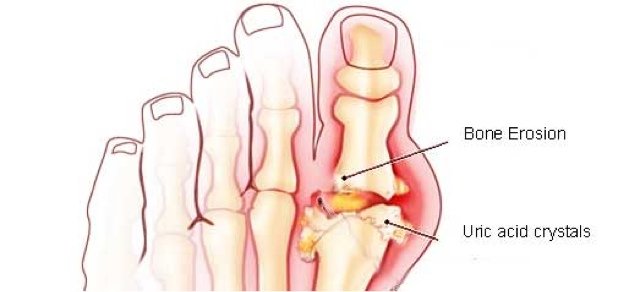 My Gout treatment: Mayo Clinic: Big Toe Isn