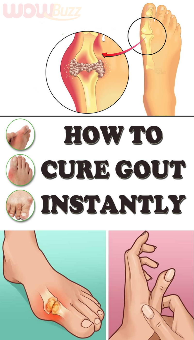 Natural Ways To Treat Gout