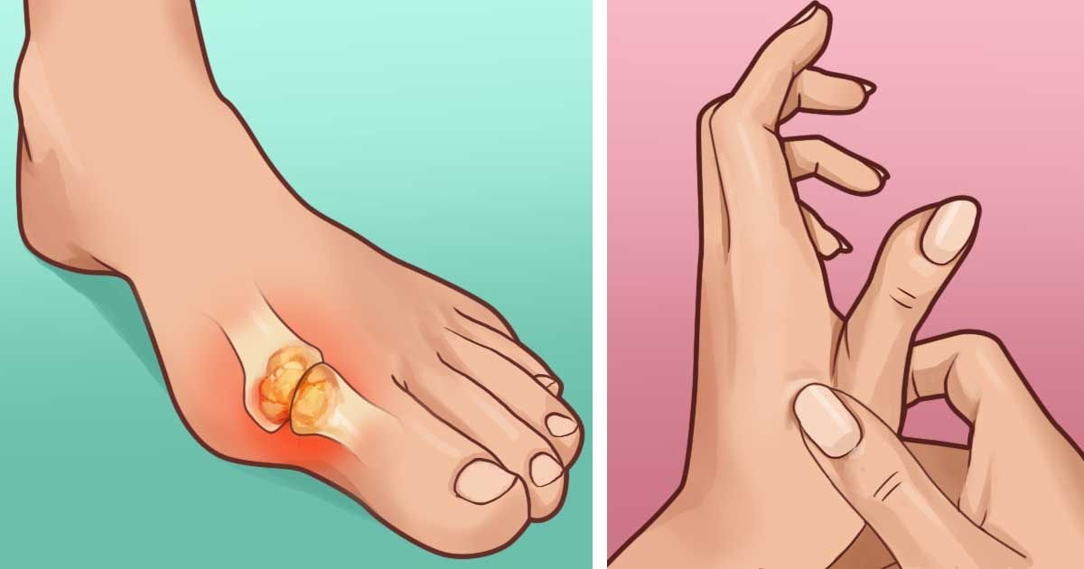 Natural ways to treat gout
