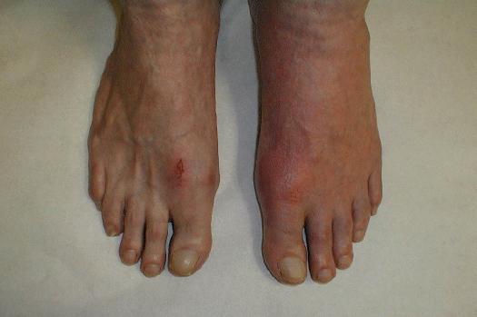 Pictures of Gout In Feet: How to Get Rid of Gout in Feet ...