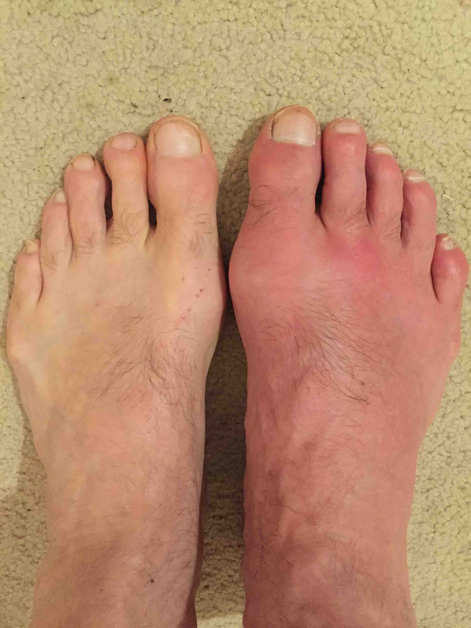 pictures of gout in feet