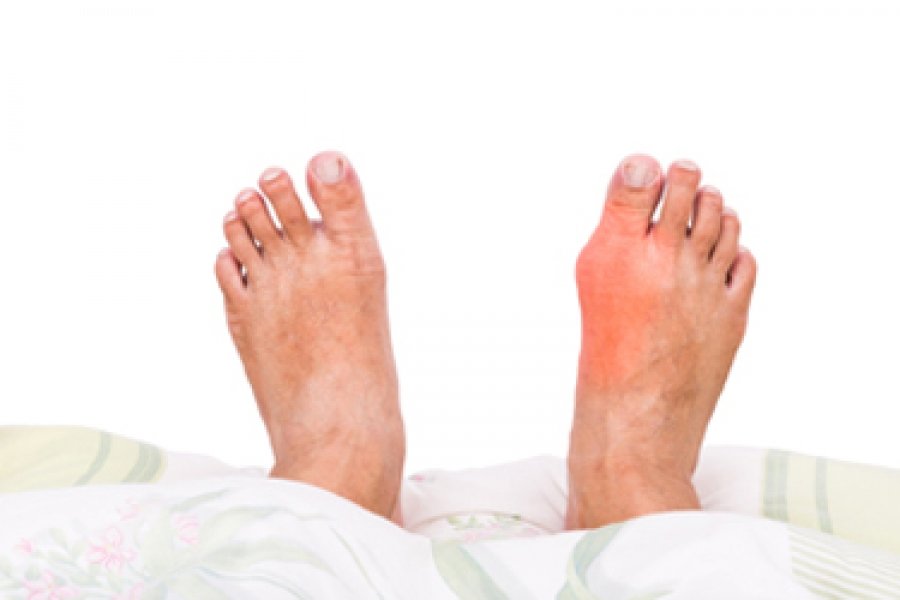 Possible Causes of Gout