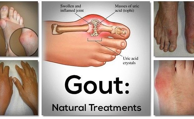 Powerful Home Remedy For Curing Gout In 7 Days