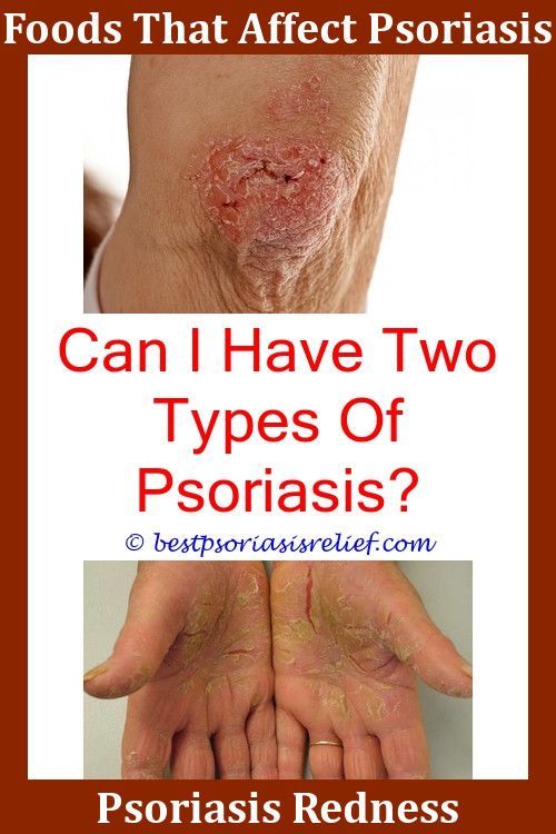 Psoriasisonfeet Best Cream For Psoriasis Over The Counter ...