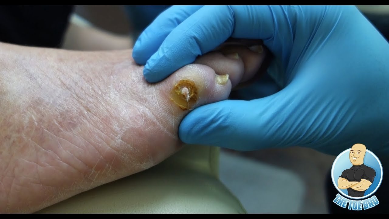 RAW UNEDITED TREATMENT: Removing Gout Crystals From A Baby ...