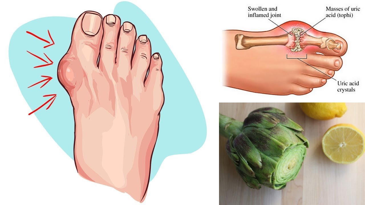 Say Goodbye to Gout and High Uric Acid Levels With This Powerful Home ...