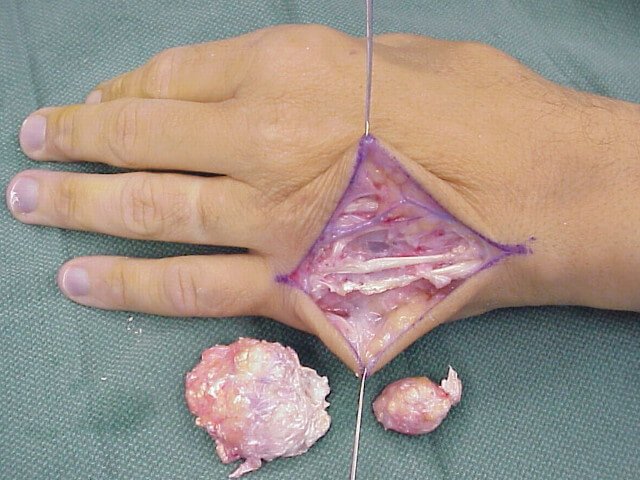 Self surgery on Gouty Tophus