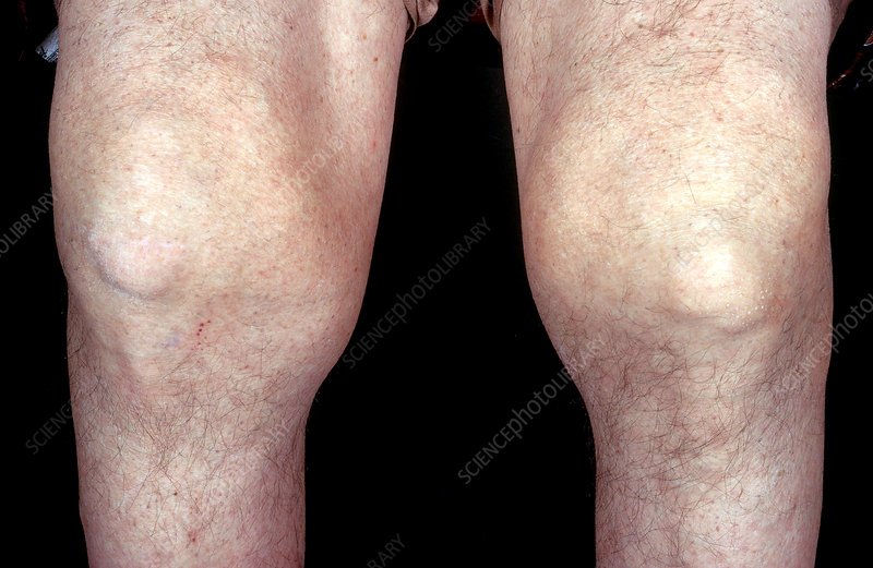 Severe Gout, Knees