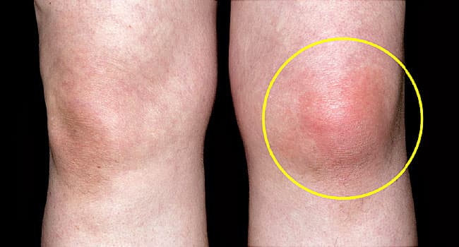 Signs Your Chronic Gout Is Getting Worse